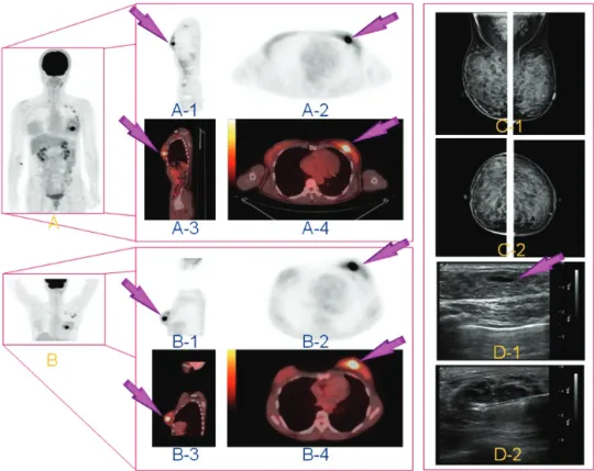 Fig. 4. FDG PET-CT scan in a patient with locally advanced breast cancer. (A) All patients were studied in the supine position