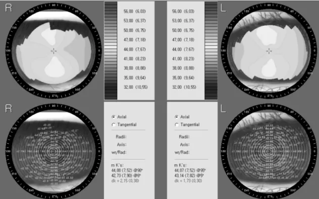 Fig. 2. The analysis of corneal topographic patterns.