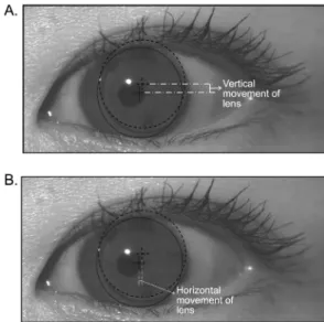 Fig. 2. Estimation of aspheric RGP lens movement.