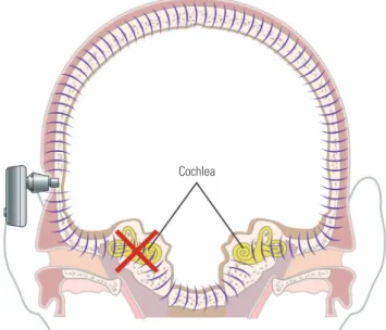 Fig. 1.  Mechanisms of a bone-conduction hearing implant. Vibrations gen- gen-erated from the device are transferred to the contralateral cochlea and  recognized on the contralateral side.