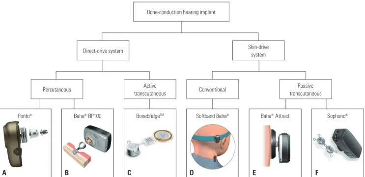 Fig. 2.  Categorization of bone-conduction hearing implants. (A) Ponto ® . (B) Baha ®  BP100