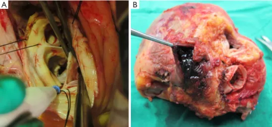 Figure 2 Cardiac computed tomography scan. (A) Before the third surgery shows multiple anastomotic pseudoaneurysms; (B) after heart  transplantation.