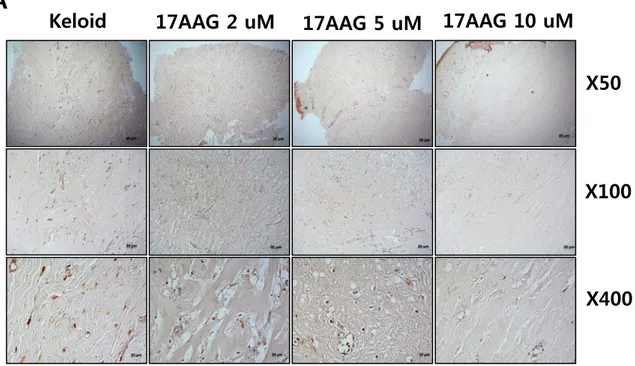 Figure 5. Immunohistochemical staining of keloid spheroid sections for typeI collagen from 17AAG-treated  keloid tissues