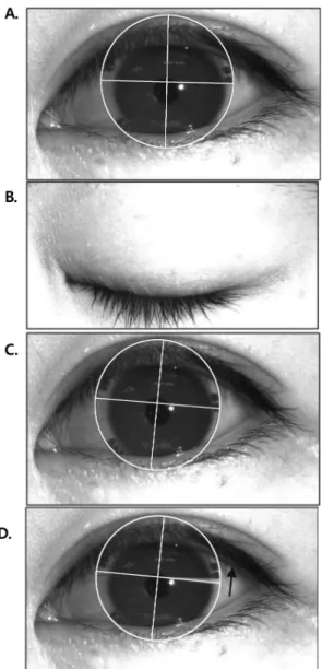 Fig. 2. The lens rotation in normal and dry eyes with align- align-ment fitting.
