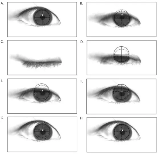 Fig. 2. Movement of RGP lens on cornea by the steps of blinking. 