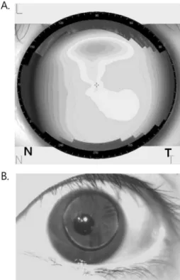 Fig. 7. Comparison of corneal topography and RGP lens centration. 