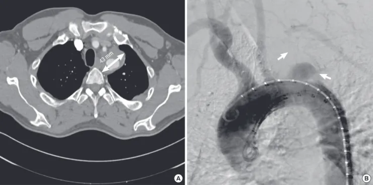 Fig. 1. Preoperative computed tomography and aortogram. (A) Computed tomography scan shows a saccular aneurysm on the distal aortic arch