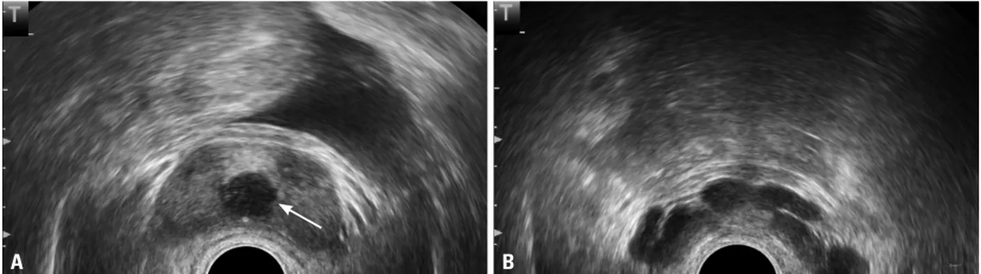 Fig. 1. Transrectal ultrasonography revealed (A) a midline prostatic cyst with an approximate diameter of 1.5 cm (white arrow) with (B) dilated seminal vesi-