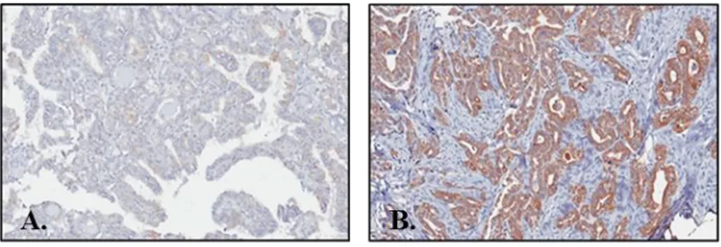 Figure 2. Representative image of immunohistochemical staining of COT in  PTC; (A) No staining, (B) Strong staining 