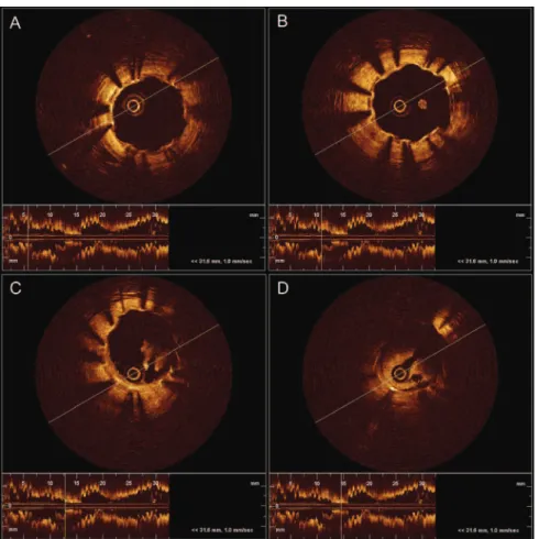 Figure 2. New thrombi were detected