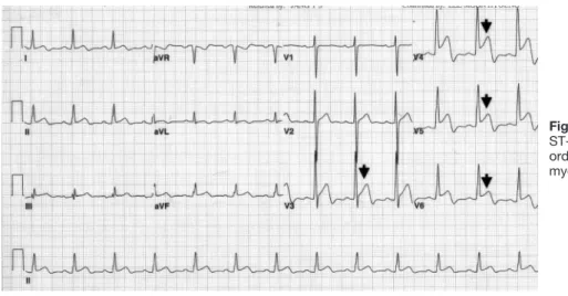 Figure 1. Initial ECG showing