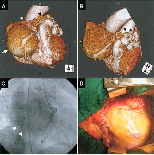 Figure 4. A and B, Multislice com- com-puted tomography findings showing a giant coronary aneurysm originating from the right coronary artery (white arrows) and draining into main  pul-monary artery (arrow heads)
