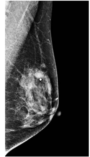 Fig. 1. A 41-year-old woman with nodular fasciitis of the breast. (a) The mediolateraloblique view of mammography showed a  10-mm-diameter oval isodense mass with partially indistinct margin in the upper center of her left breast (with a BB-marker).