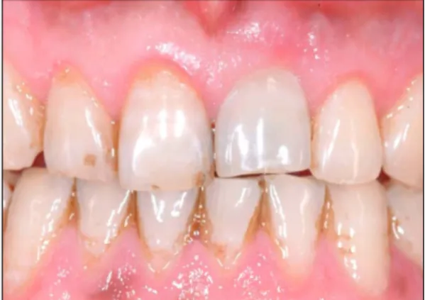 Fig. 4. Frontal view of the final restoration. Five soft tissue esthetic