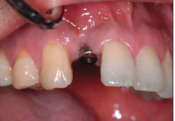 Fig. 6. A healing abutment was placed on the day of surgery (pic-