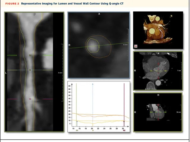 FIGURE 2 Representative Imaging for Lumen and Vessel Wall Contour Using Q-angio CT
