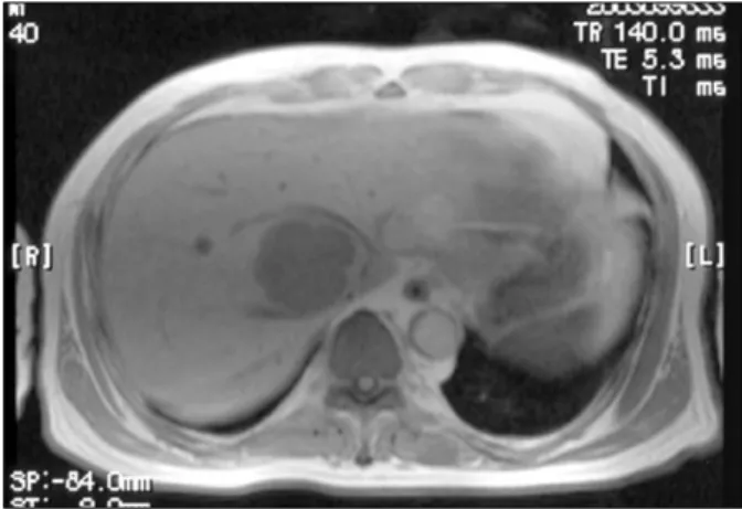 Fig. 4. The cut surface shows a yellowish-white nodule that is firm and well circumscribed.