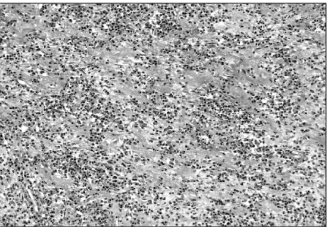 Fig. 5. Histologic findings of the tumor reveals a mixture of chronic inflammatory cells in which the polyclonal plasma cells predominate in a background of fibrotic stroma
