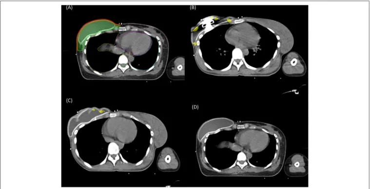 FIGURE 1 | Contoured structures for reconstructed breast radiation therapy (A). Red, 5 mm strip of the skin over the reconstructed breast; green, chest wall clinical target volume including the skin