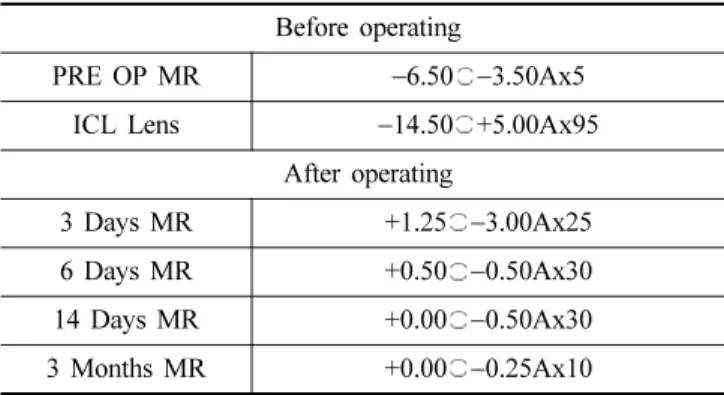 Table 2. Another clinical case of ICL prescription  Before operating