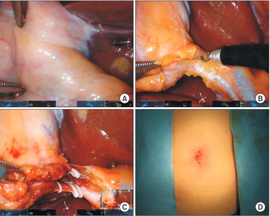 Fig. 2.  Procedure description of  the robotic SP chole cystectomy.  With effective gallbladder  retraction (A), calot trianlge is  dissected by using remaining  two robotic artms (B)