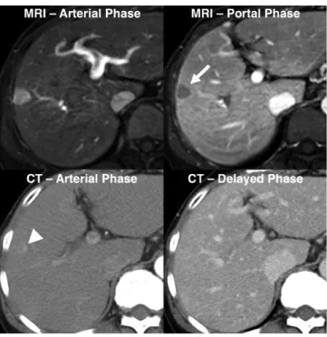 Table 2. Diagnostic Performance of CT and Gadoxetate-Enhanced MRI for Hepatic Malignancy 