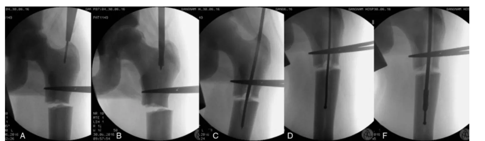Figure 2. Sequential processes of medullary canal reaming. A. After placement of the 3.2-mm threaded guide pin on the starting point, the entry point was double- double-checked in the anteroposterior and axial views