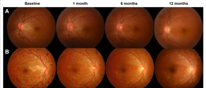 Fig. 2 Representative figures at each time point of two cases of Ozurdex-treated central retinal vein occlusion (CRVO) eyes with cilioretinal artery occlusion