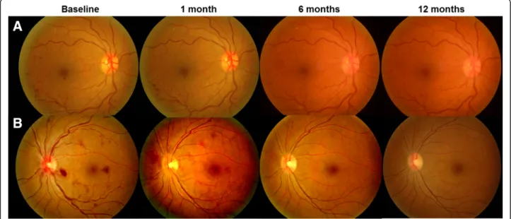 Fig. 3 Representative figures of untreated (a) and Ozurdex-treated (b) central retinal vein occlusion eyes at each time point