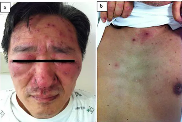 Fig.  1.   Clusters  of  erythematous  papules  and  crusts  are  seen  on  the  patient’s  face  (a)