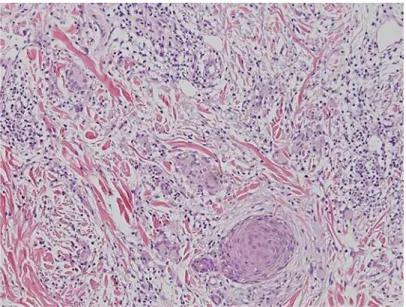 Fig. 2.  Skin biopsy showing interstitial granulomatous dermatitis with a few eosinophils, extravasated red 