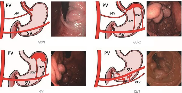 Figure 1.  Classification of gastric varices. PV, portal vein; LGV, left gastric vein; SV, splenic vein; GOV, gastroesophageal varices; PGV, posterior gastric  vein; SGV, short gastric vein; IGV, isolated gastric varices; GEV, gastric epiploic vein.