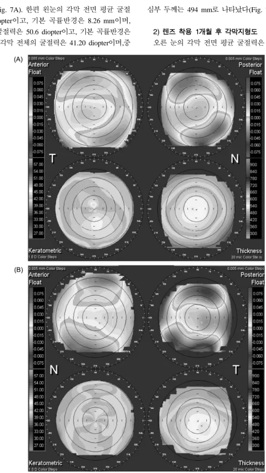 Fig. 8. Example of the ORB scan recording cornea by corrected vision in binocular after one month using moderate myopia of ez NONOsence II RGP contact lens