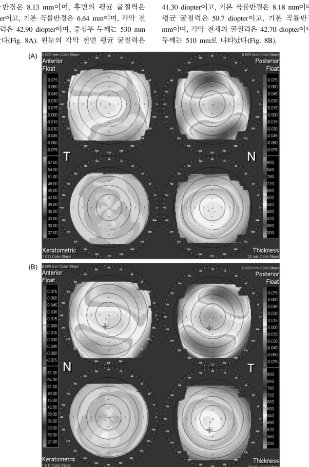 Fig. 9. Example of the ORB scan recording cornea by corrected vision in binocular after three month using moderate myopia of ez NONOsence II RGP contact lens