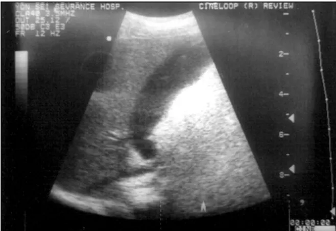 Fig. 2. On the ninth day of Kawasaki disease, acute acalculous distention of the gallbladder (hydrops) was identified by an abdominal ultrasound in a one-year-old boy.