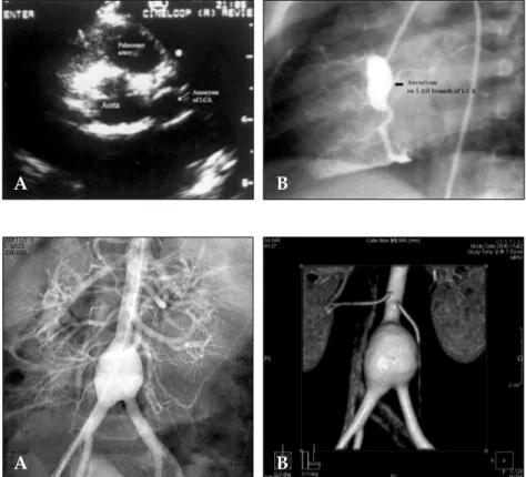 Fig. 6. Abdomial aortogram (A) and a 3D-image of the computed tomogram (B) showing the aneurysm of the distal abdominal aorta, just below the origin of inferior mesenteric artery (IMA) with an involving bifurcation.
