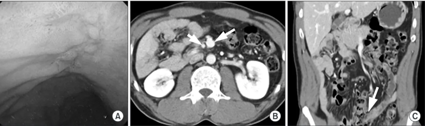 Fig. 1. Preoperative evaluation. (A) Esophagogastroduodenoscopy. (B) Computed tomography axial view