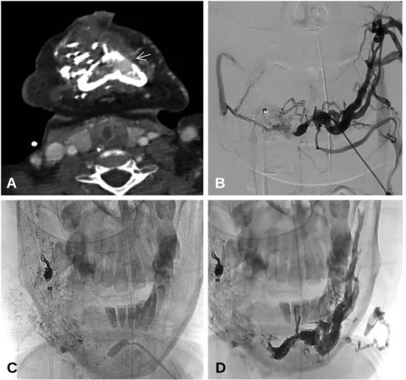 Fig. 2. Venous congestion on follow-up CT and venogram showing venous embolization process