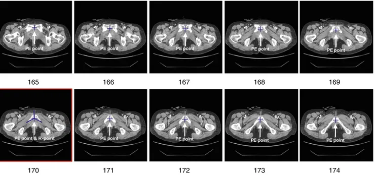 Fig. 1 Successive CT images with the structure of SP and their levels in an axial stack