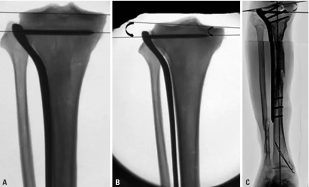 Fig. 1. (A) JSA=0: proximal most screw (PMS) is parallel to the joint line. (B) JSA (-): PMS tilted in varus with tip pointing towards joint line
