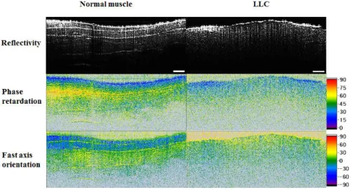 Fig. 8. Comparison between normal chest muscle and LLC of mouse using PS SD-OCT. The  image  scales  are  as  follows:  reflectivity  image  (logarithmic  scale),  phase  retardation  image  (color, °) and cumulative fast axis orientation image (color, °)