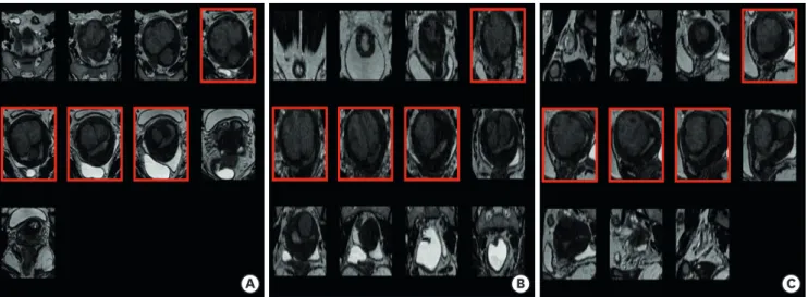 Fig. 3.  Process of selecting the fibroid slides on each plane. (A) Axial plane. (B) Coronal plane
