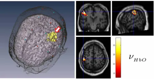 Fig. 7. Activation area for HbO using MUSIC (q < 0.05, corrected. df=2). The cross hair in coronal, sagittal and horizontal section indicates the position of the peak value of MUSIC spectrum.