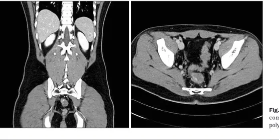 Fig. 1. Abdominopelvic enhanced  computed tomography. A colon  polyp with active bleeding is found.