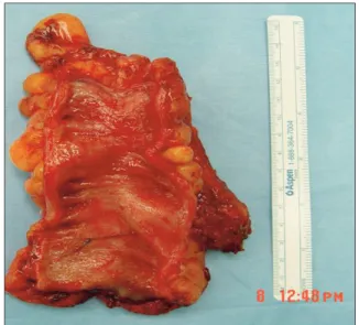 Fig. 4. Surgical specimen. There is no residual tumor or metastasis to  the lymph nodes.