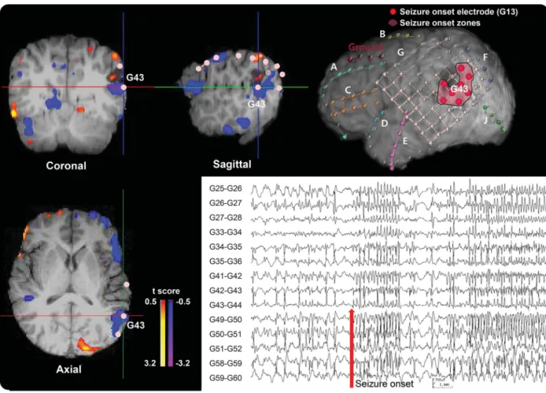 Figure 2 Example of the icEEG SOZ/ICC intra2inter map comparison in a 15-year-old male with lesional temporal lobe epilepsy