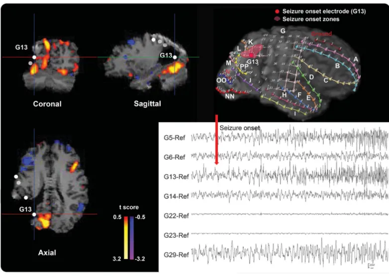 Figure 3 Example of the icEEG SOZ/ICC intra2inter map comparison in a 33-year-old woman with lesional extratemporal lobe epilepsy