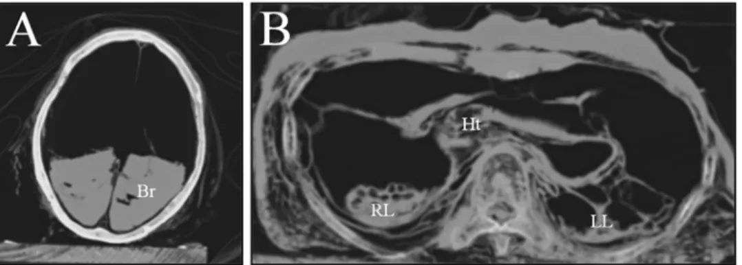 Fig 2. The CT images of this case. (A) for head; (B) for thorax. Most mummified organs were displaced to the dorsal side of body cavities
