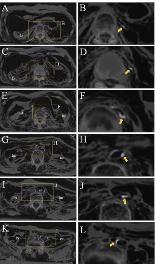 Fig 3. The CT images showing calcifications in aorta wall. (A) to (D) Upper abdomen. Calcifications (pointed by yellow arrows) are seen in the wall of abdominal aorta (dotted circles)
