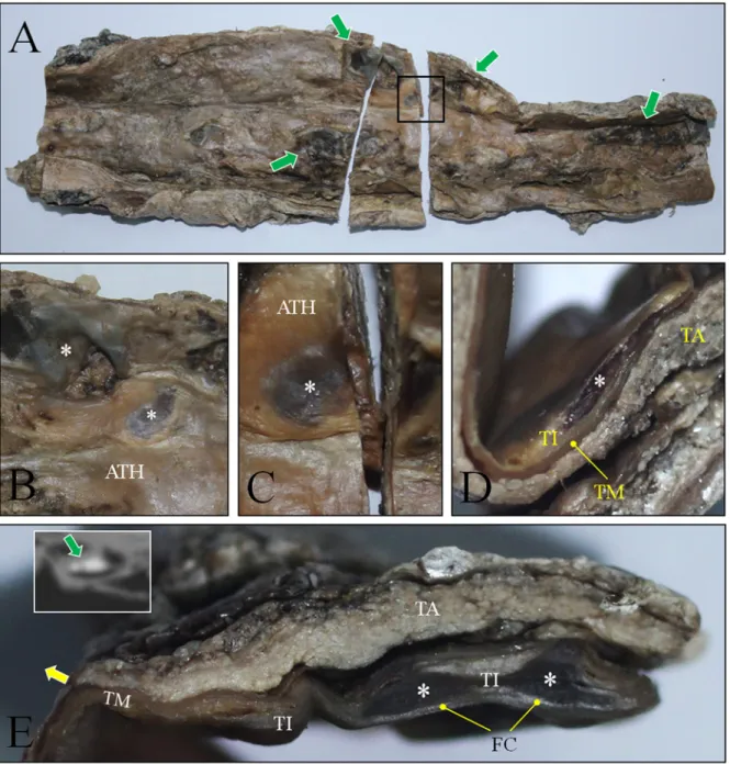 Fig 5. Cross-section of abdominal aorta. (A) Longitudinal section was done on the anterior wall to expose the inside of aorta